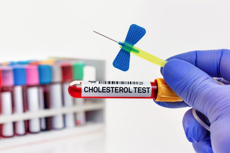 Blood samples of patient for cholesterol test in laboratory. doctor with Blood tube for cholesterol test in biochemistry lab