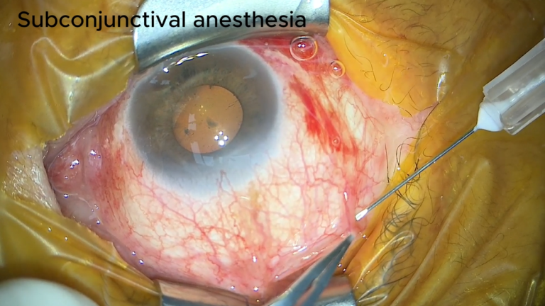 VOD 제목 'Atream을 이용한 여과수술 방법'의 대표 이미지