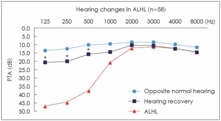 기사 제목 '급성저음역난청의 최신지견'의 대표 이미지