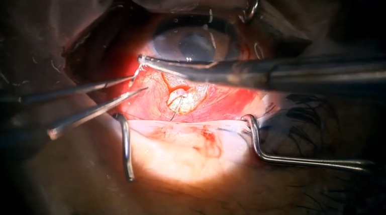 VOD 제목 'WOO 저널 V17N1_Ripcord 각막고정술 김준모 교수님 증례 참고 영상'의 대표 이미지