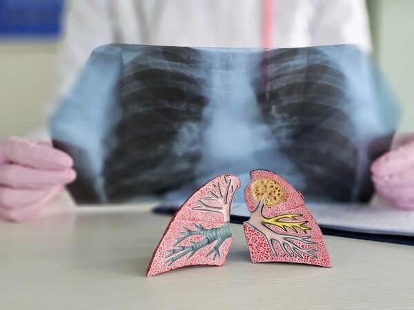 Pneumonia pulmonary diseases anatomy of the lungs and a magnifying glass in the hands of a doctor. Pneumonia asthma bronchitis symptoms and first signs and time of treatment