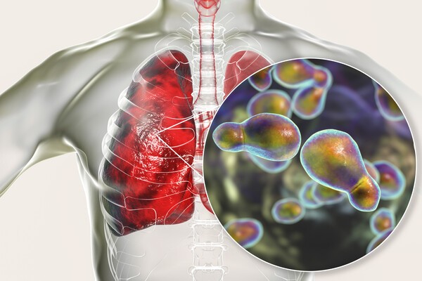 Pulmonary cryptococcosis, invasion of a lung tissue by yeast fungi Cryptococcus neoformans with close-up view of the fungi, computer illustration.